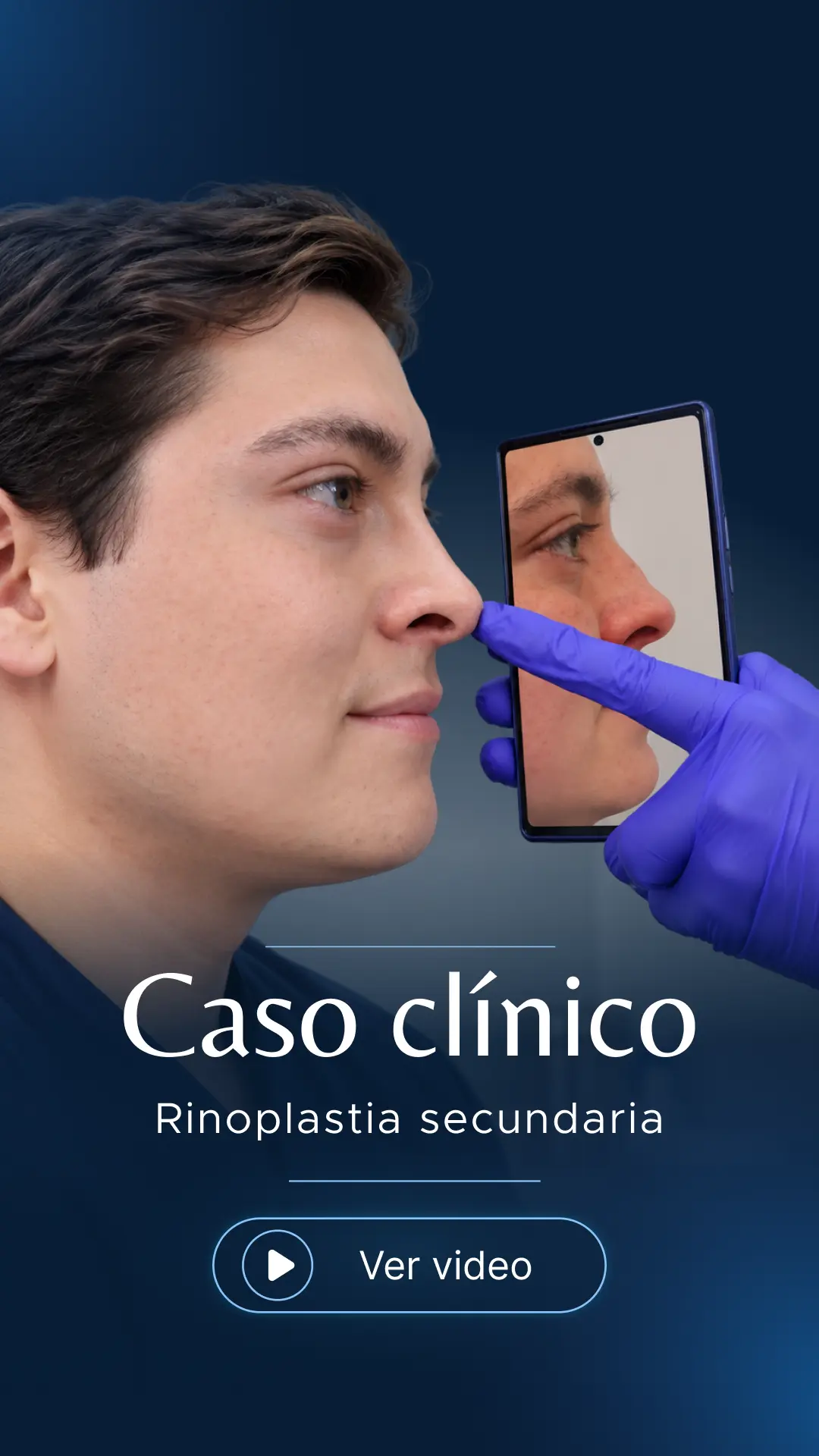 Caso clínico: rinoplastia secundaria