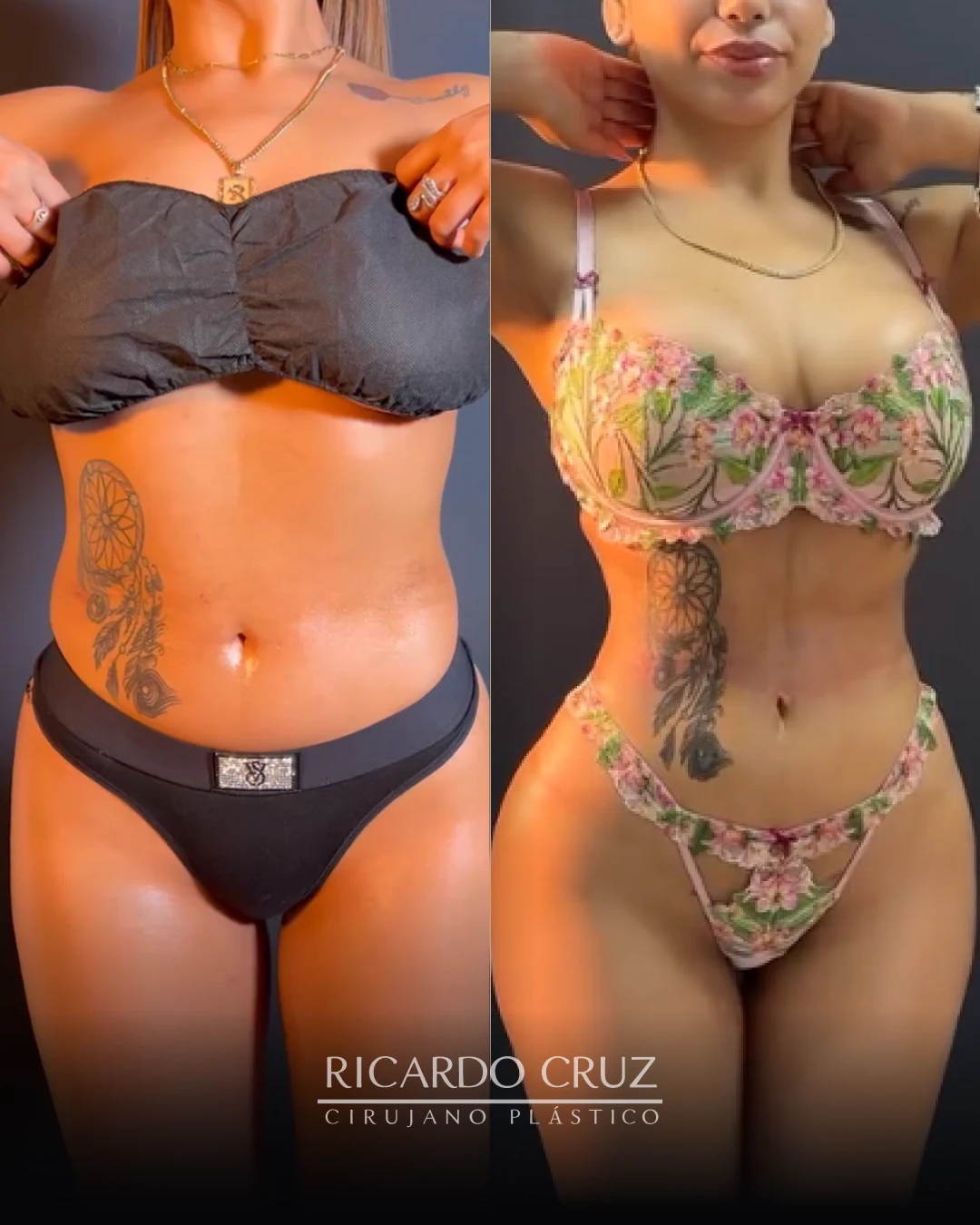 Caso 1 de lipoescultura secundaria con Heus + Retraction y RIBXCAR: vista frontal antes y al mes de la cirugía