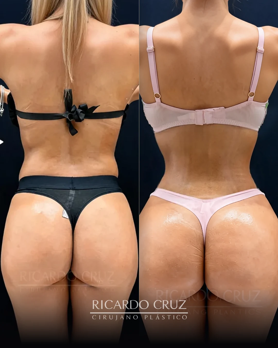 Caso 2 de lipoescultura secundaria con Heus + Retraction y RIBXCAR: vista posterior antes y después de la cirugía