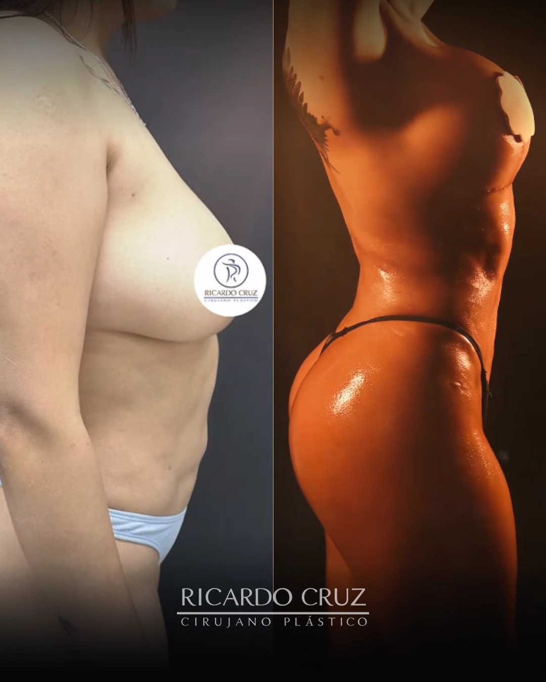 Caso 3 de lipoescultura, mastopexia con prótesis y RIBXCAR: vista lateral antes y después de la cirugía