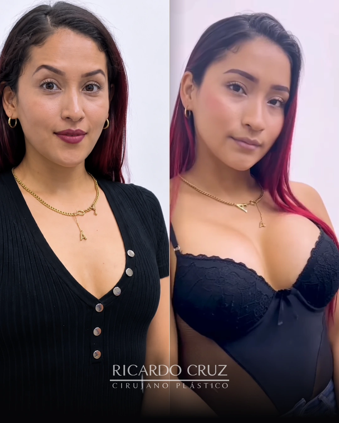 Caso 2 de mamoplastia de aumento: comparación antes y después de la cirugía