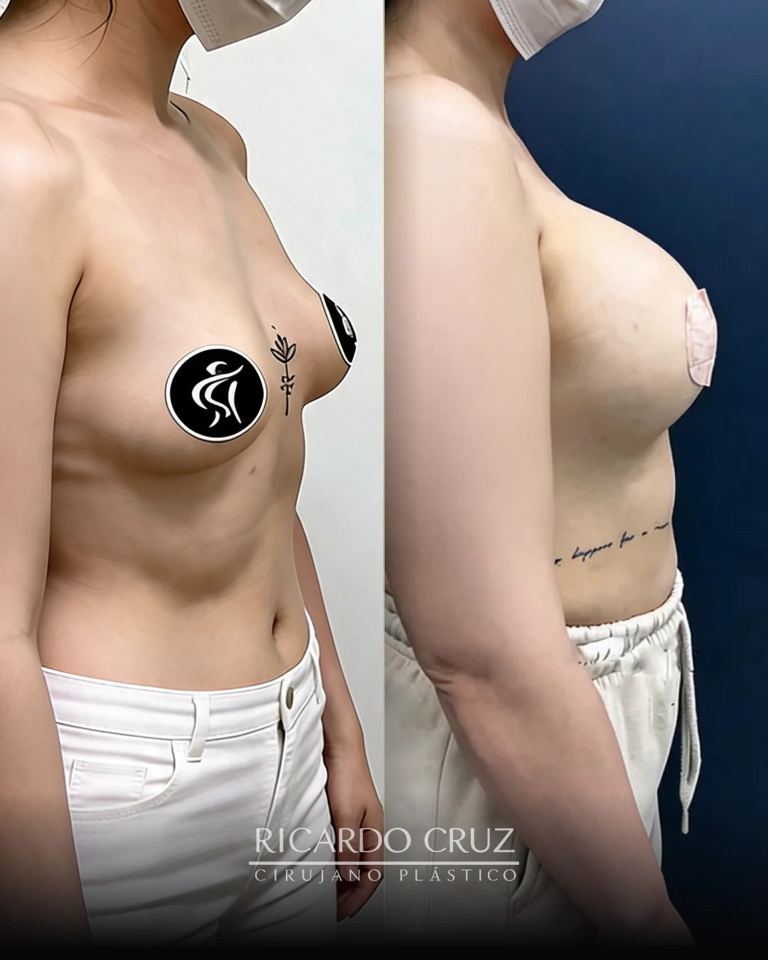 Caso 3 de mamoplastia de aumento con prótesis de 350 cc: vista lateral antes y a las 3 semanas de la cirugía