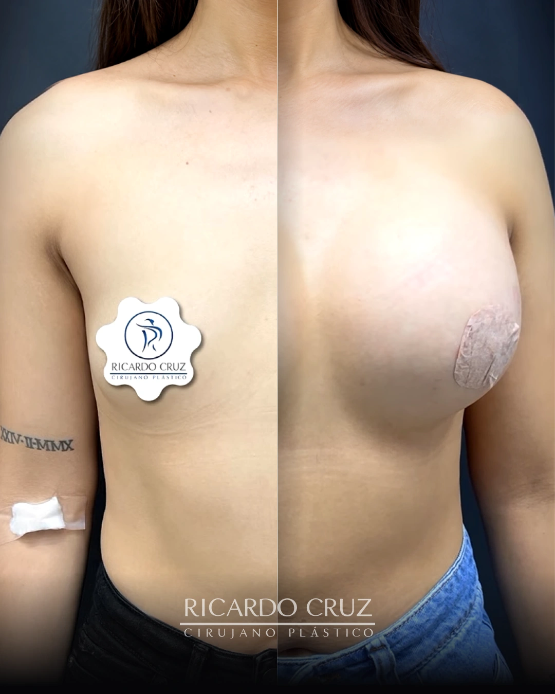 Caso 4 de mamoplastia de aumento con prótesis de 375 cc: comparación antes y a los 2 meses de la cirugía