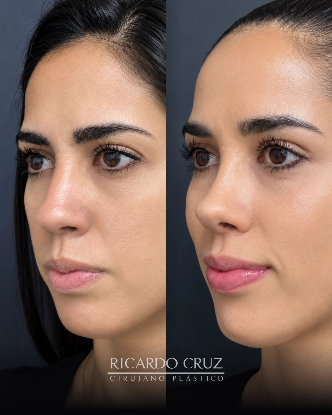 Caso 1 de rinoplastia: fotografías antes y después