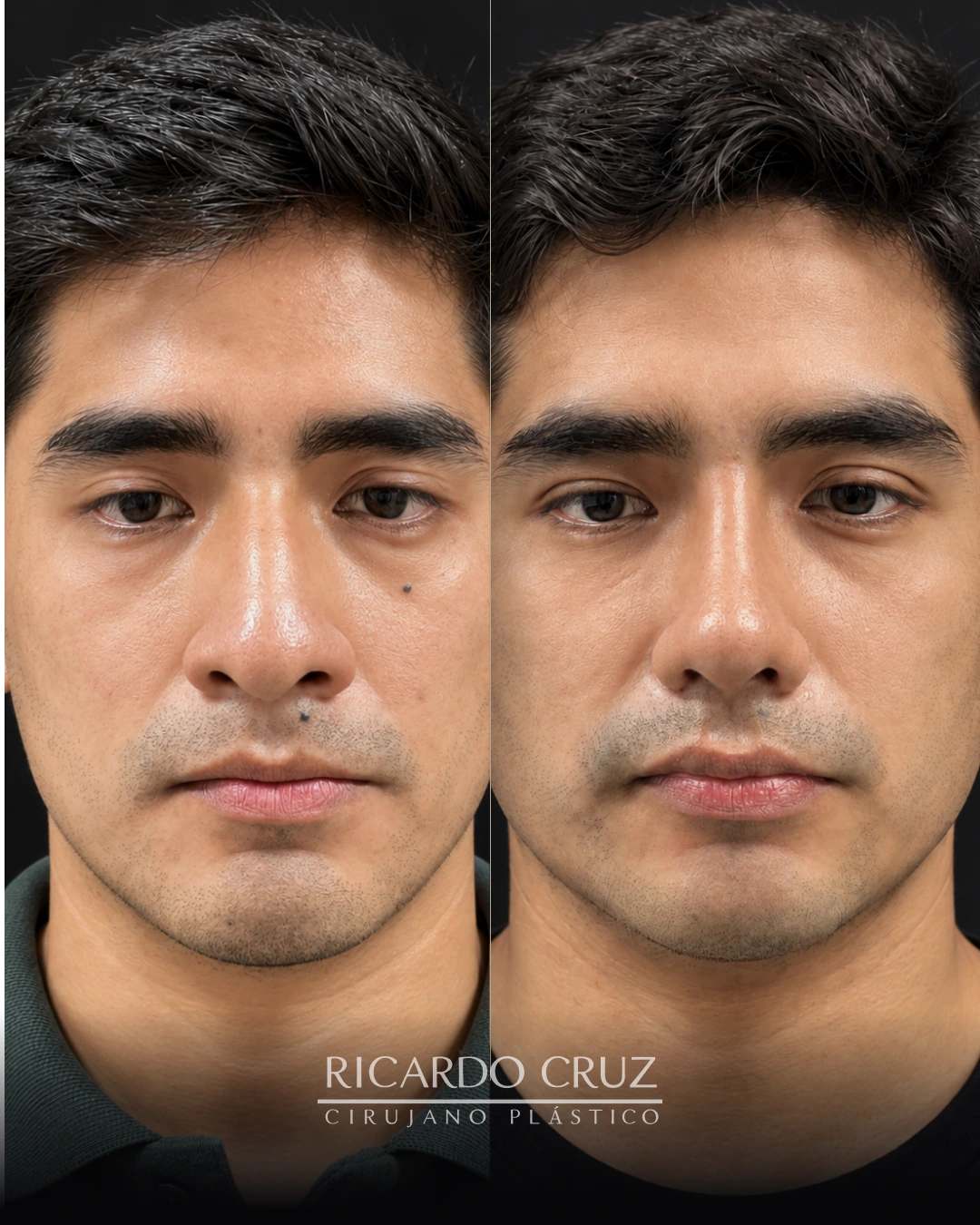 Caso 2 de rinoplastia: fotografías antes y después