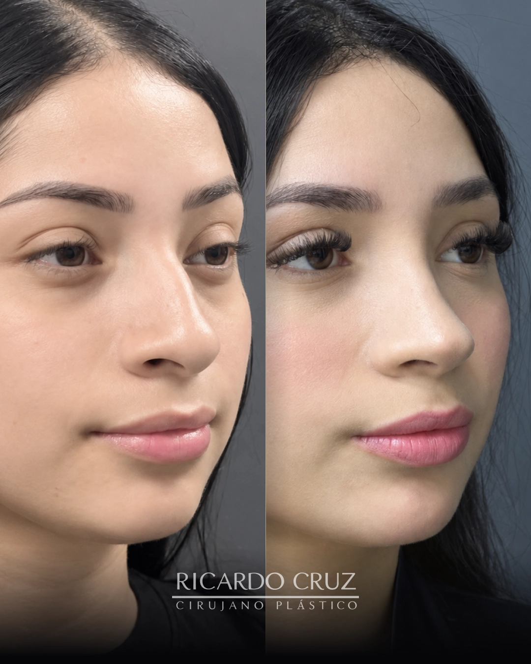 Caso 3 de rinoplastia: fotografías antes y después