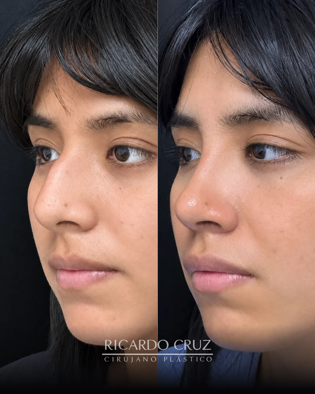 Caso 4 de rinoplastia: evolución al mes y a los 3 meses