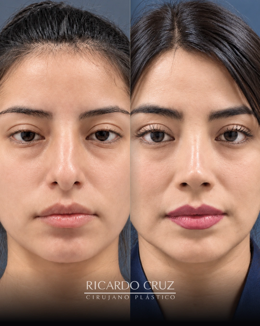 Caso 5 de rinoplastia: evolución a los 3 y 18 meses