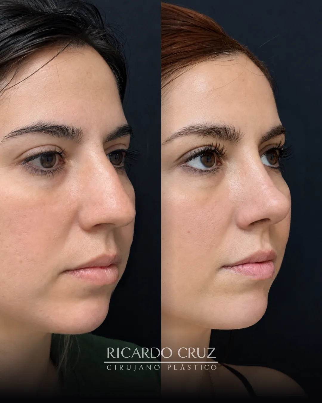 Caso 6 de rinoplastia: evolución a los 2 y 6 meses