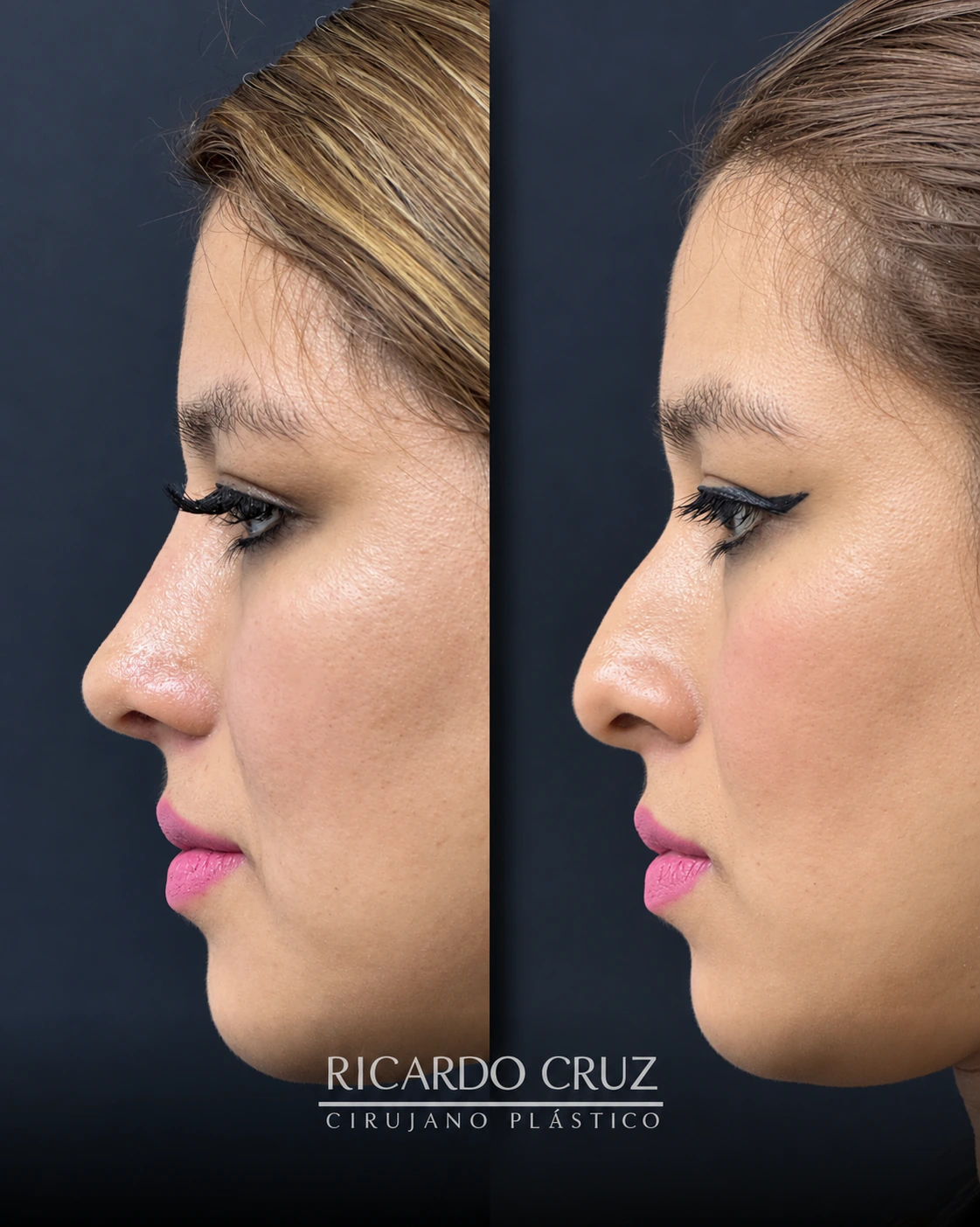 Caso 8 de rinoplastia ultrasónica: resultado al mes a la izquierda y antes de la cirugía a la derecha
