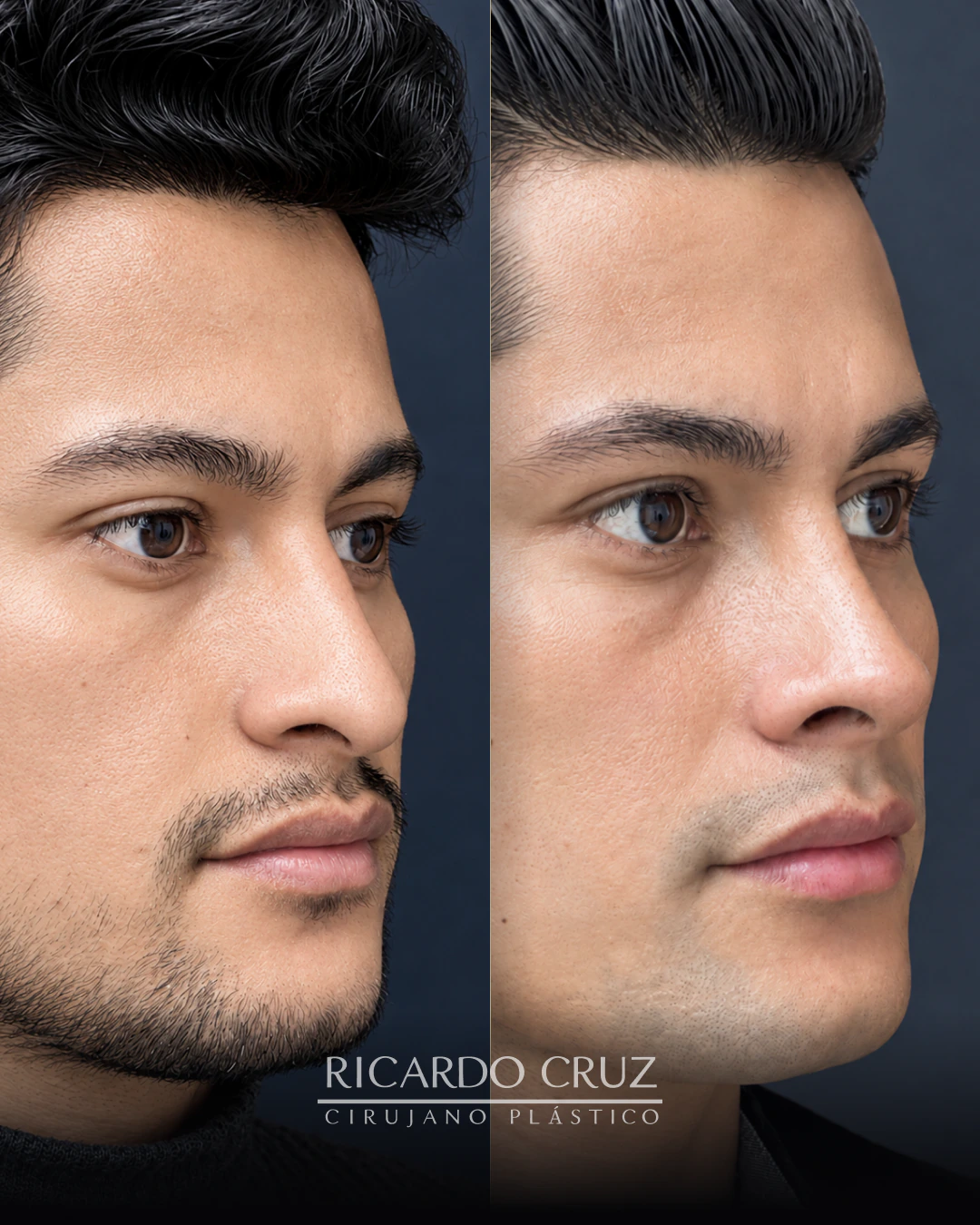 Caso 9 de rinoplastia de preservación ultrasónica: antes y control a los 2 años