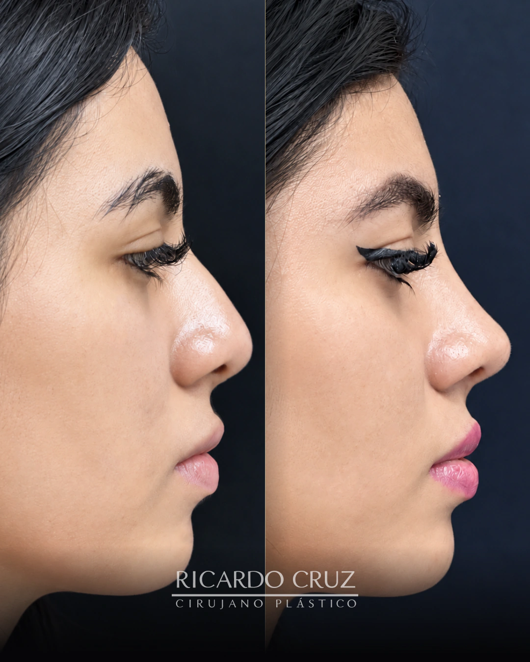 Caso 10 de rinoplastia de preservación ultrasónica: antes y control a los 4 meses
