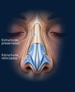 Vista anatómica frontal de rinoplastia híbrida