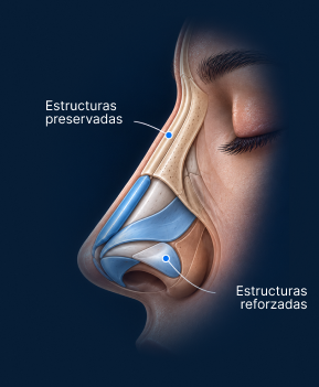 Vista anatómica lateral de rinoplastia híbrida