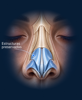 Vista anatómica frontal de rinoplastia de preservación ultrasónica