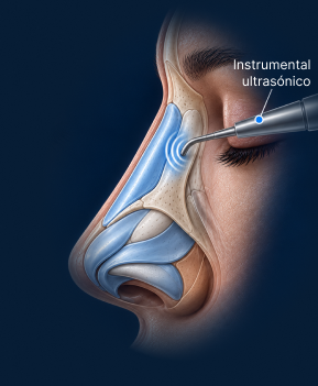 Vista anatómica lateral de rinoplastia ultrasónica