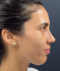 Perfil de la paciente una semana después de la rinoplastia.