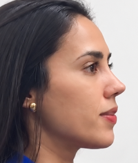 Perfil de la paciente tres meses después de la rinoplastia.