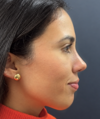 Perfil de la paciente seis meses después de la rinoplastia.
